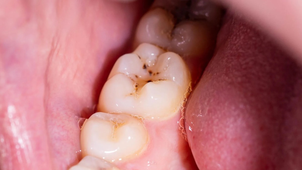 Goodbye, cavities? New gel could regrow tooth enamel