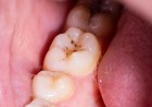 Goodbye, cavities? New gel could regrow tooth enamel