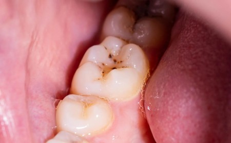 Goodbye, cavities? New gel could regrow tooth enamel